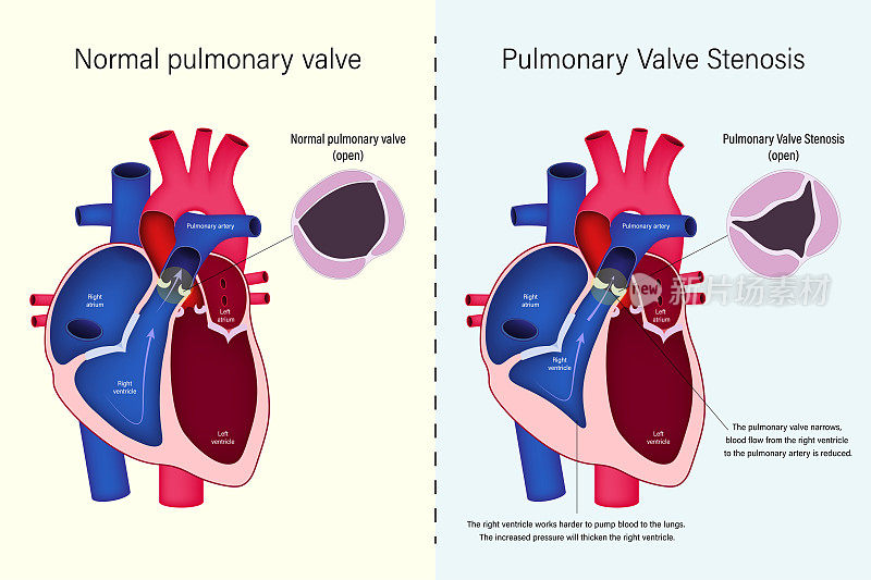 正常肺动脉瓣与肺动脉瓣狭窄向量的差异。先天性心脏病。