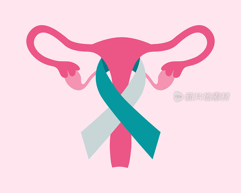 人类子宫与宫颈癌意识丝带。子宫颈癌认知概念