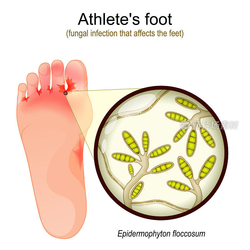 脚气。真菌感染影响足部。