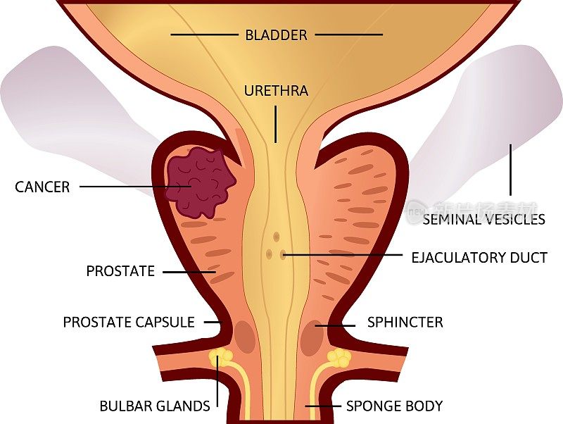 前列腺癌第二阶段。肿瘤很大，位于前列腺。