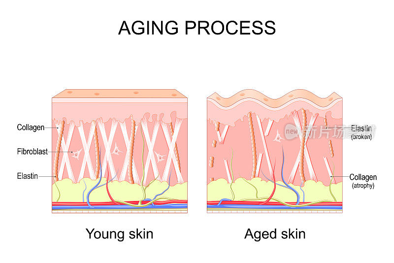 衰老过程。年轻和衰老皮肤的比较。胶原蛋白，弹性蛋白和成纤维细胞