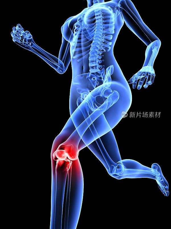 膝关节疼痛的女性骨骼电脑x光片