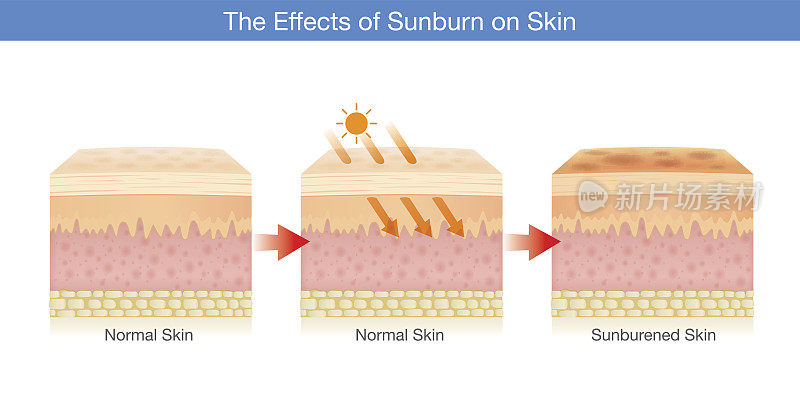 因阳光而受损的人体皮肤层的变化。