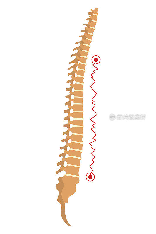 脊柱畸形。脊柱弯曲或不健康的脊骨的象征。人体脊柱解剖学，弯曲脊柱。带标记部分的图表。身体姿势的缺陷
