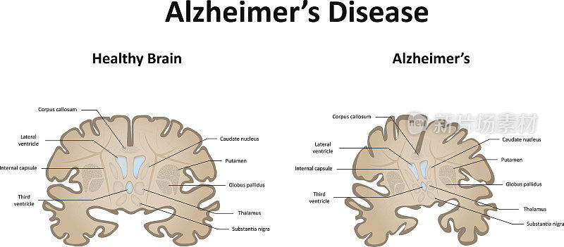 大脑和运动系统的阿尔茨海默病