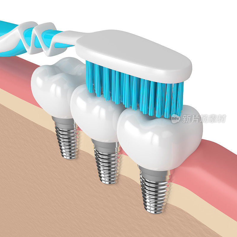 牙种植体与牙刷的3d渲染