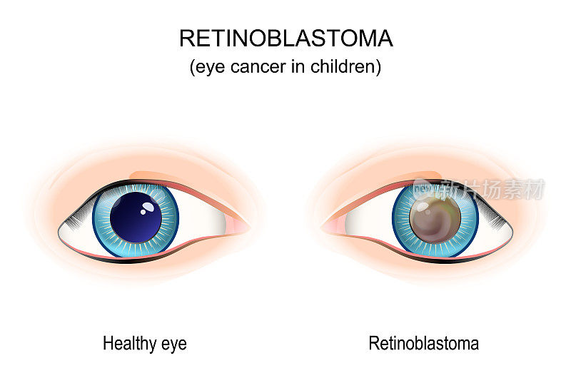 视网膜母细胞瘤。眼癌