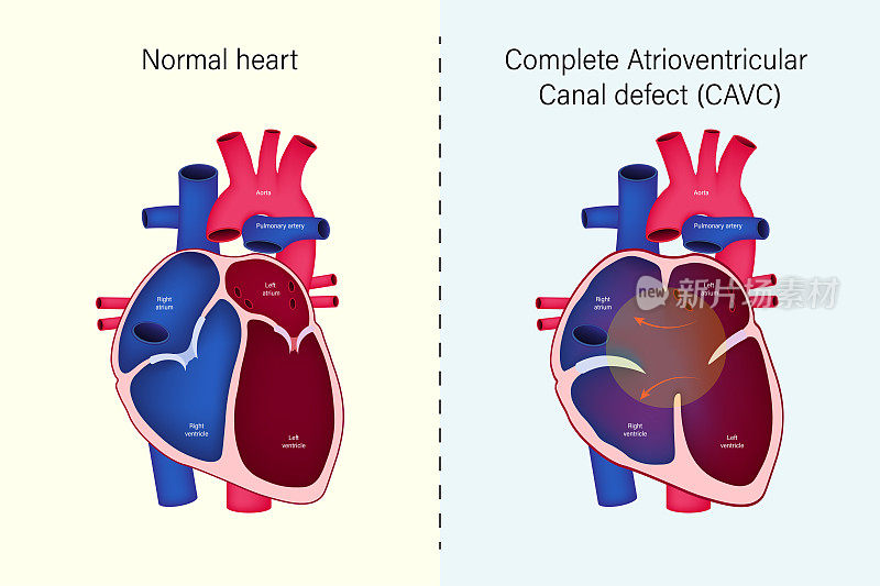 正常心脏与完全性房室管缺损(CAVC)载体的差异。先天性心脏病。