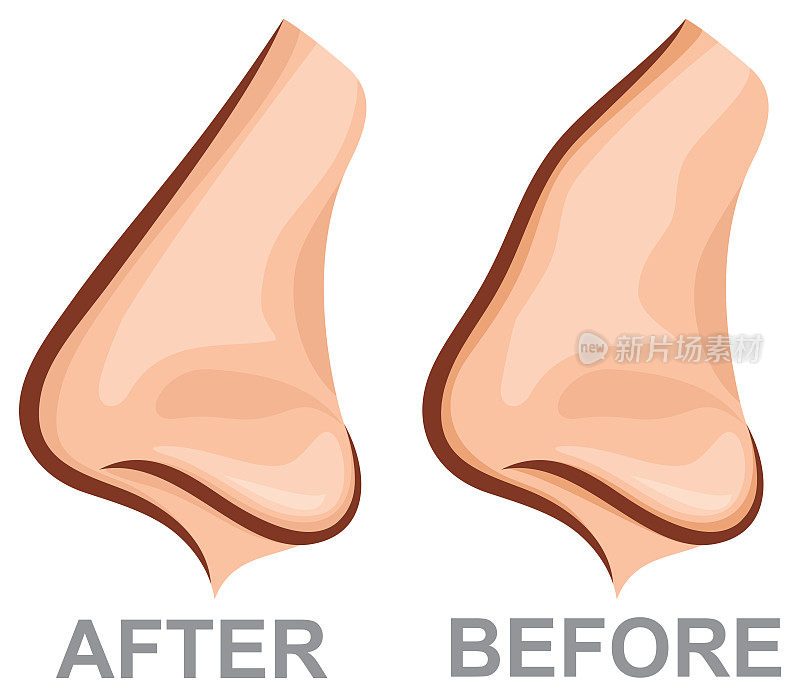 鼻整形前后的鼻子(整形手术矢量图)