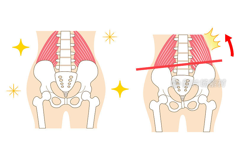左右倾斜的骨盆和腰方肌