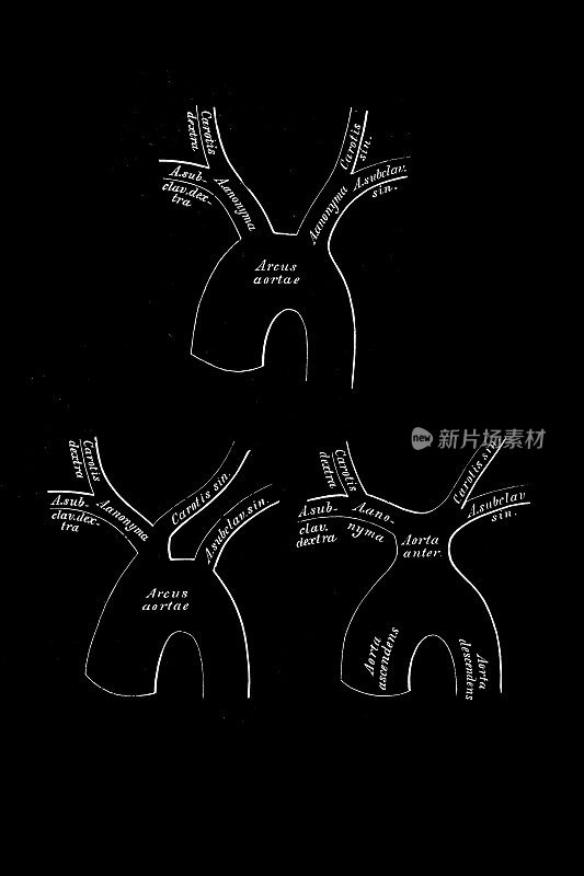 由主动脉弓缩小而产生的各种动脉的方案
