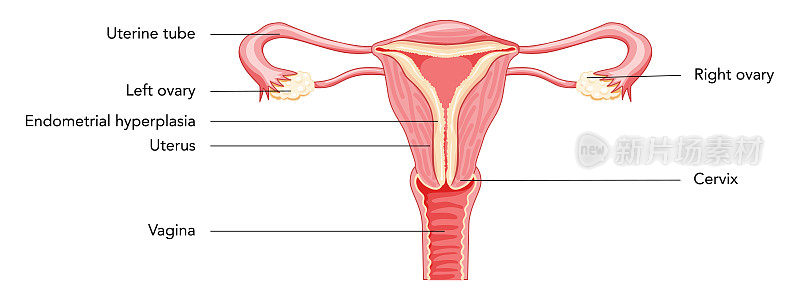 子宫内膜增生女性生殖系统子宫不同样式图配铭文前视图切面。人体解剖内部器官疾病定位方案扁平式图标