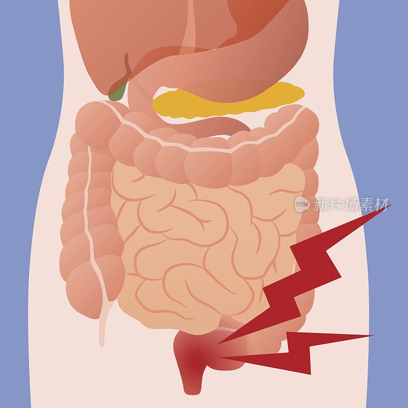 肠炎肠和人体消化器官的炎症