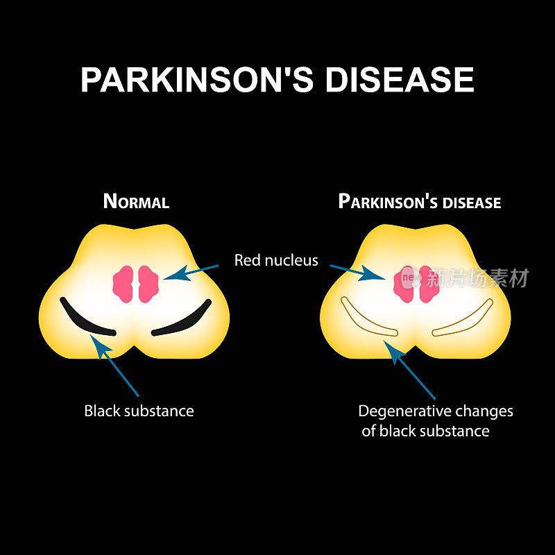 帕金森病。大脑的退行性变化是一种黑色物质。矢量插图上的黑色背景。