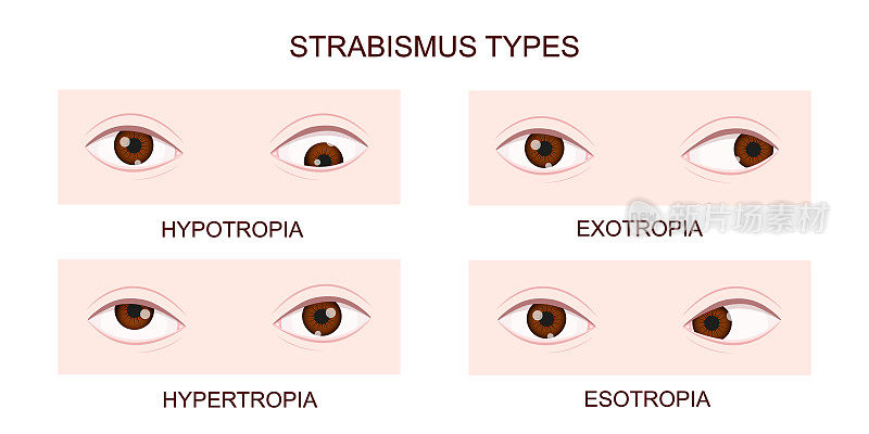 斜视类型。斜视，远视，外斜视，内斜视。有不同斜视障碍的人眼。交叉眼条件