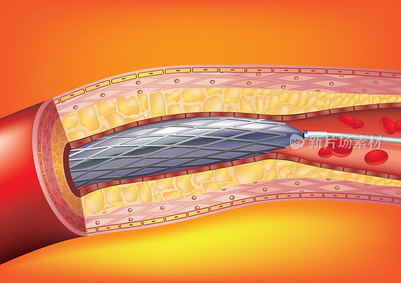 血管成形术和支架置入术