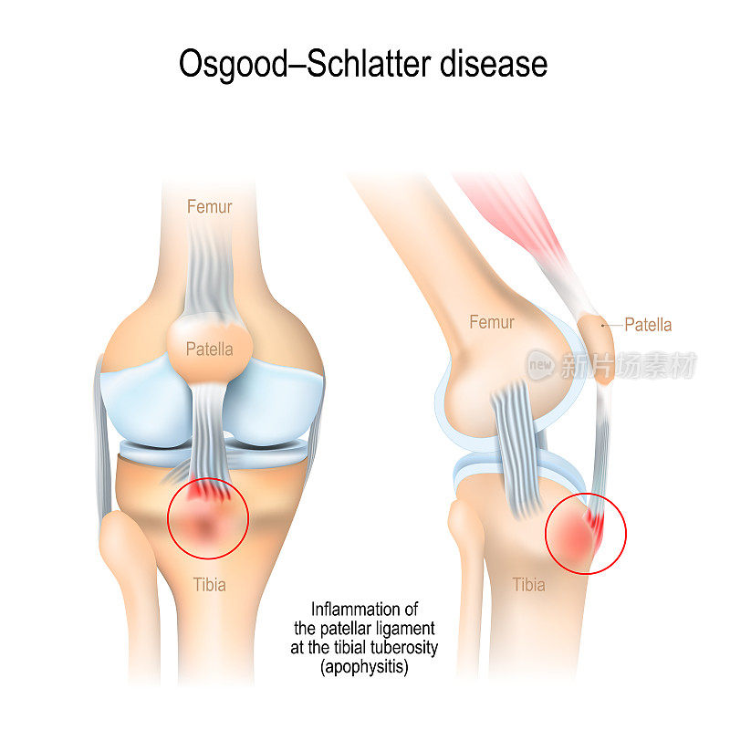 Osgood-Schlatter疾病。胫骨粗隆处的髌韧带发炎