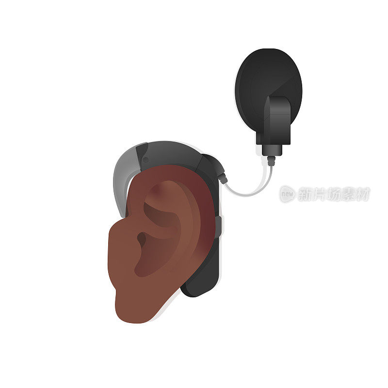 深色皮肤的耳朵，植入黑色耳蜗以帮助听力丧失