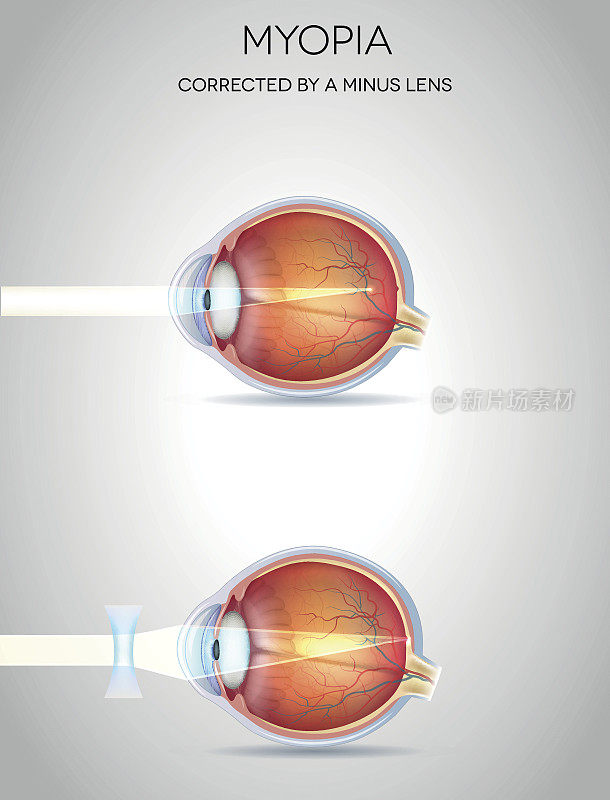 近视眼和近视眼用减透镜矫正