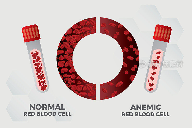 贫血铁红细胞医学载体插图医学。