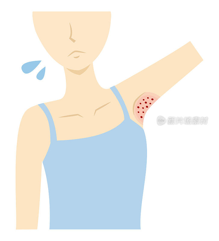 女性腋下有红色脱发炎症痤疮