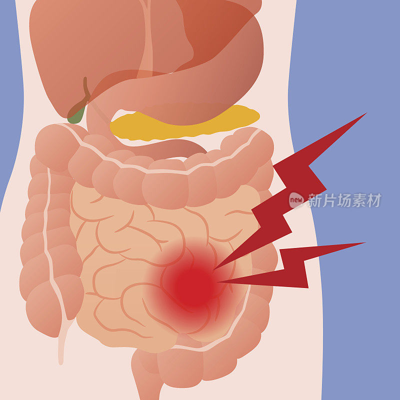 肠道和人体消化器官炎症，病媒说明