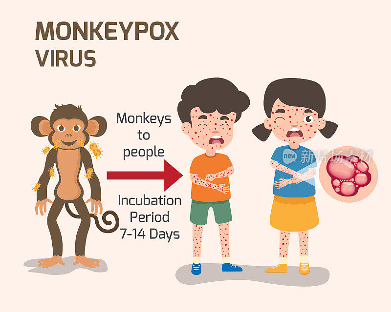 猴痘病毒成分，人体有皮疹。疾病症状，淋巴结肿大，病媒说明。