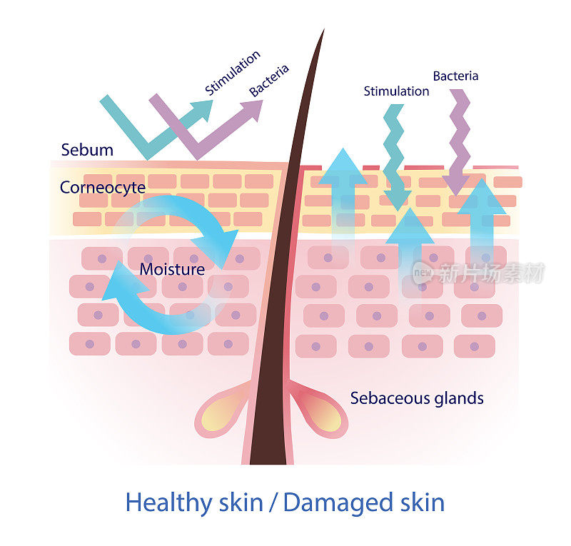 健康皮肤和受损皮肤屏障向量在白色背景。