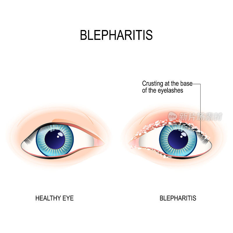 人类的眼睛。睑缘炎。眼睑边缘结皮