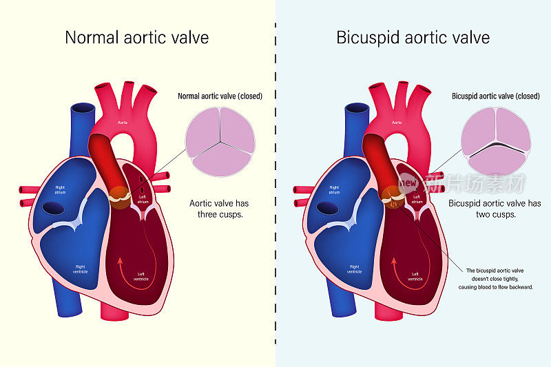 正常心脏瓣膜与二尖瓣主动脉瓣向量的差异。先天性心脏病。主动脉瓣返流。