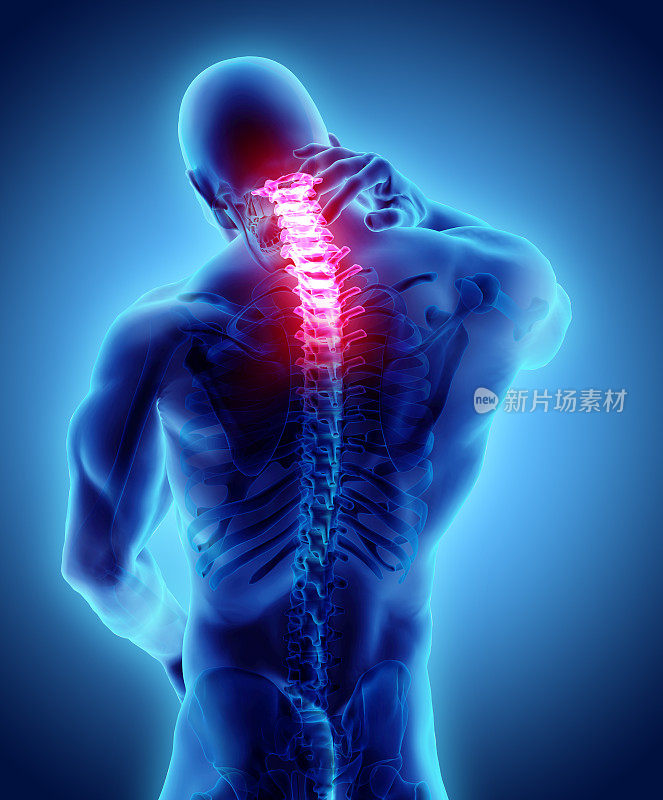 颈部疼痛骨骼x光，3D插图。