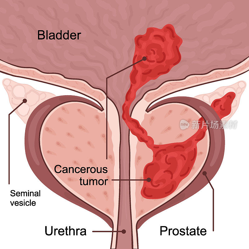 前列腺癌4期医学图示。肿瘤生长并渗透到邻近的器官和组织。