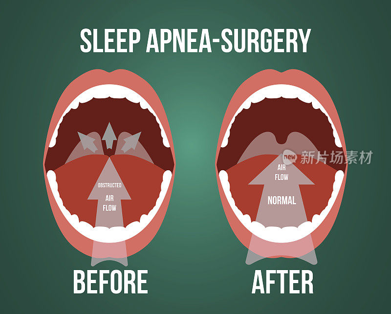 阻塞性睡眠呼吸暂停手术矢状图。