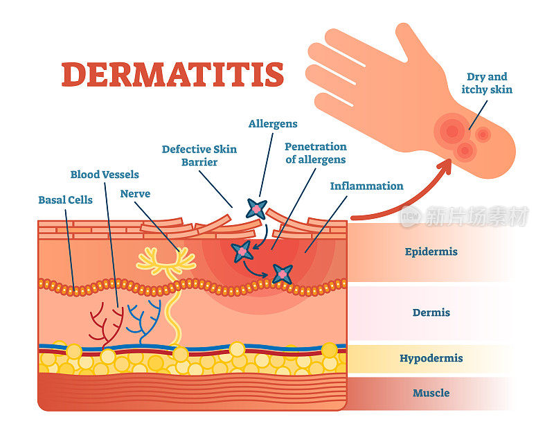皮炎平面矢量图解与皮肤层和过敏原运动。