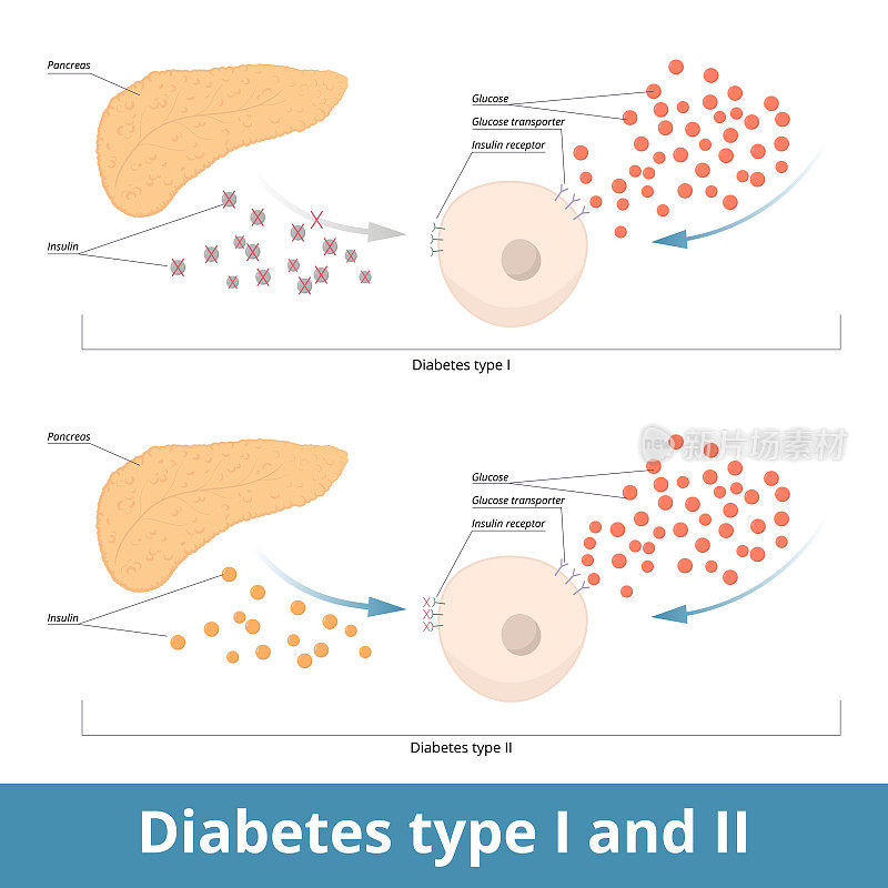 I型和II型糖尿病