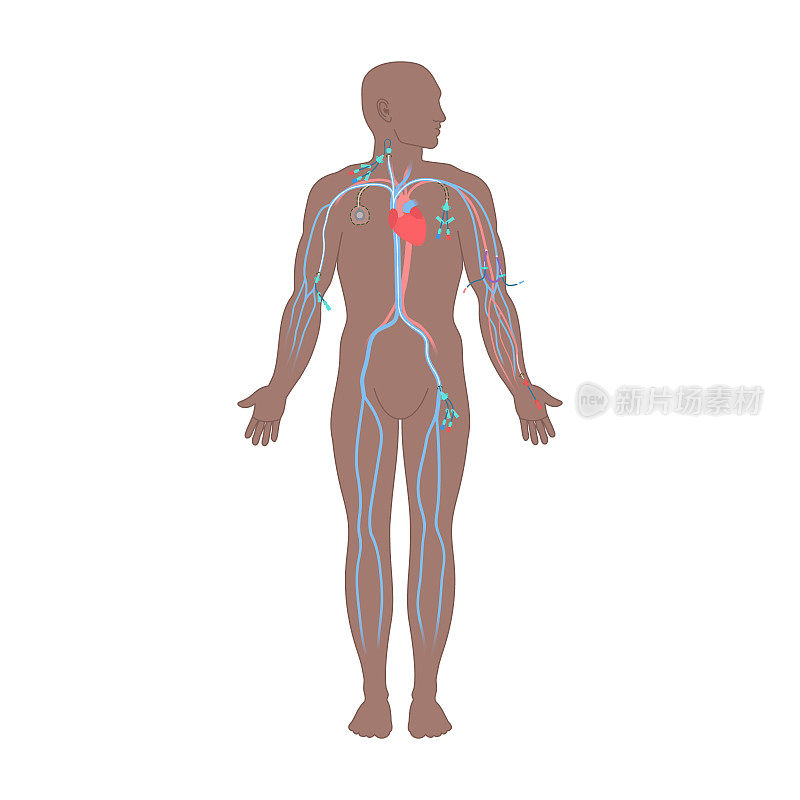 男性身上的中心静脉导管类型