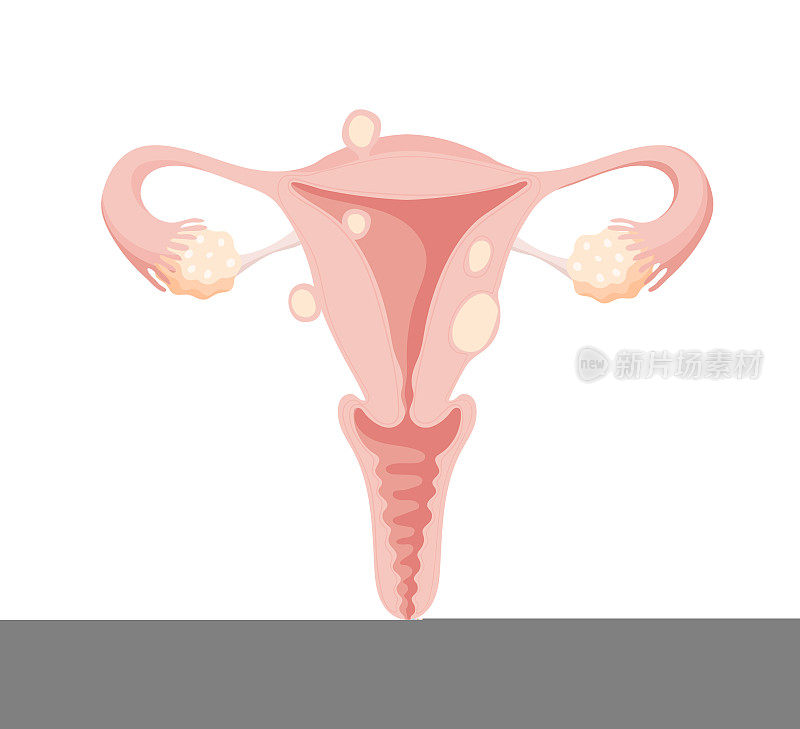 女性子宫不同类型肌瘤，现代医学治疗良性肿瘤。平面分离载体解剖插画，女性保健，妇科。