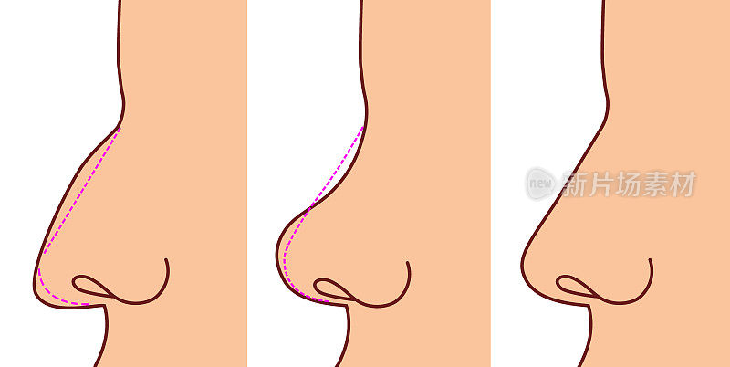 鼻子上的整形手术。之前和之后