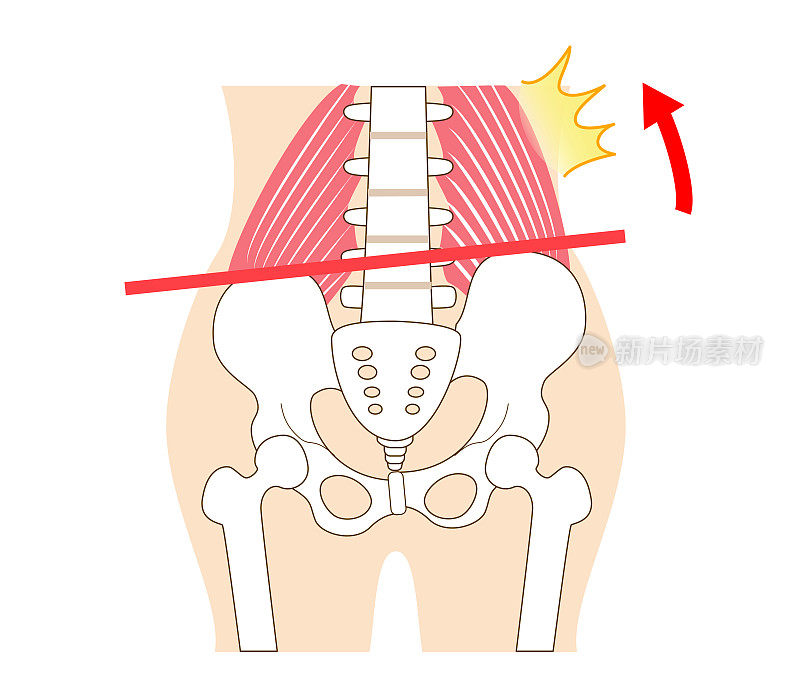 左右倾斜的骨盆和腰方肌