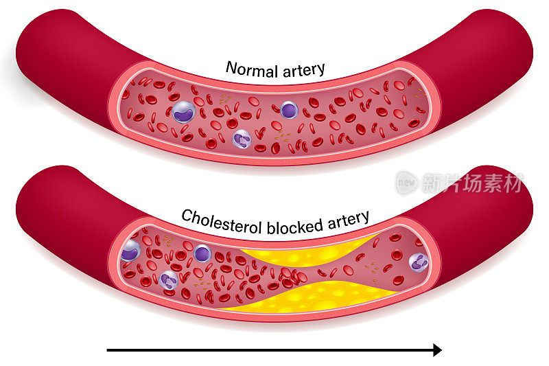 正常动脉与胆固醇阻塞动脉的差异。由胆固醇引起的动脉阻塞。