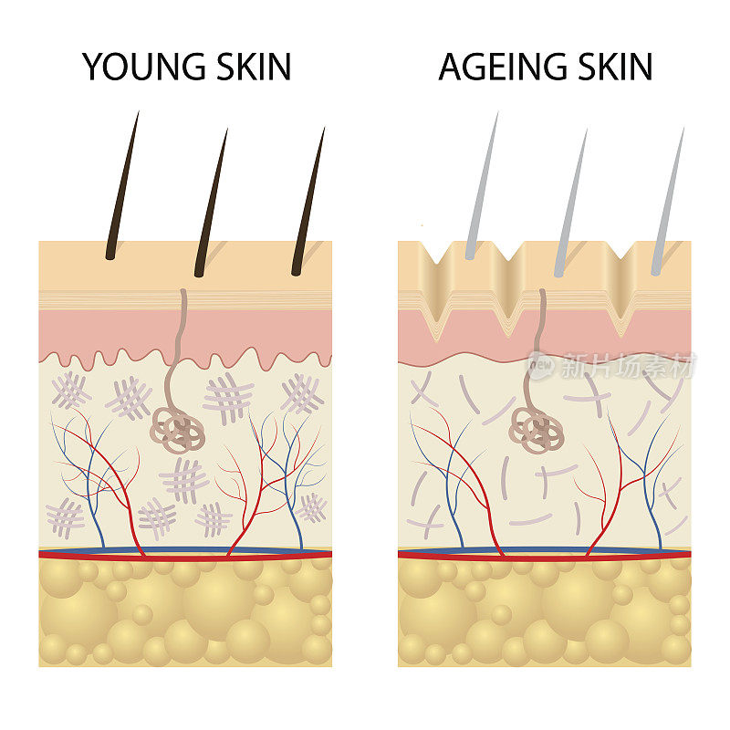 年轻健康的皮肤和老年皮肤的比较。