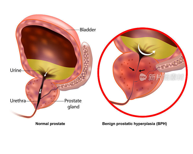 医学图示显示良性前列腺增生BPH和正常前列腺。前列腺增大