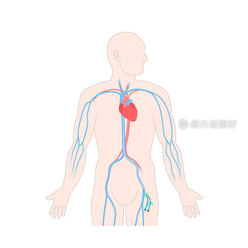 男性身上的股中央静脉导管