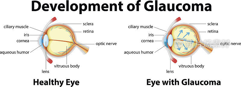人类青光眼的发展