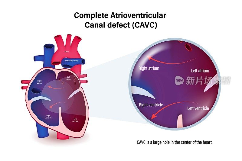 完全房室管缺损(CAVC)载体。先天性心脏病。