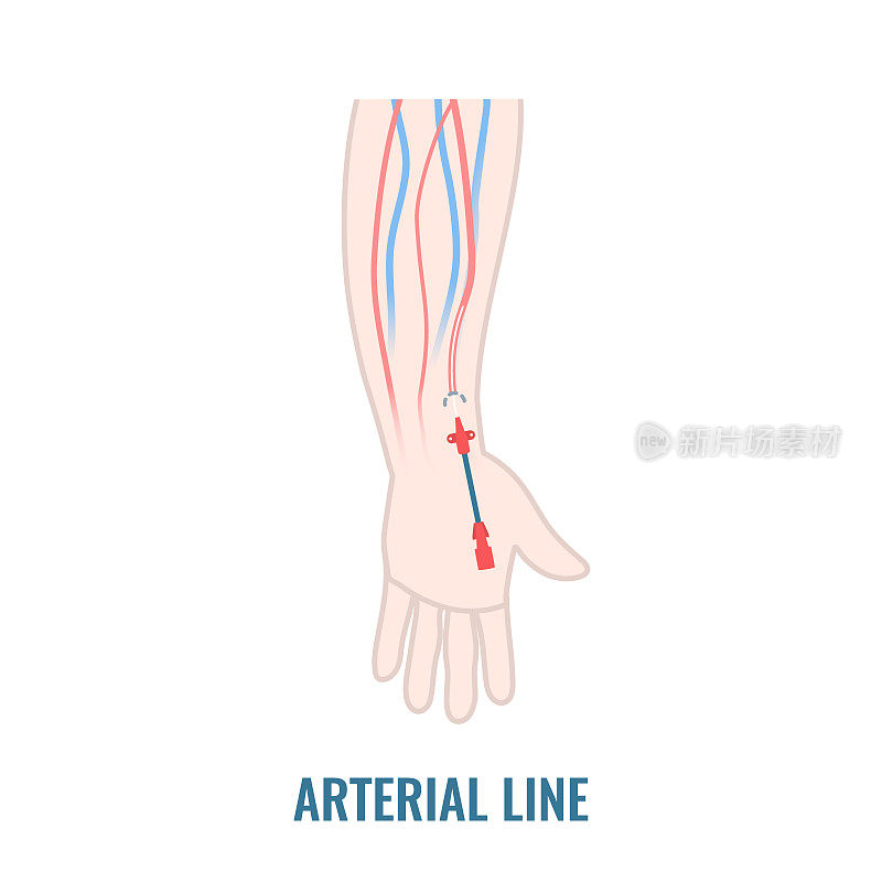 动脉导管置入桡动脉