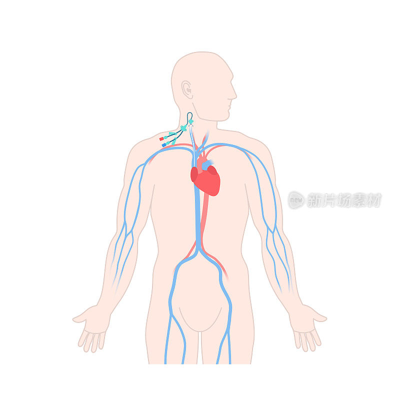 颈静脉中心静脉导管
