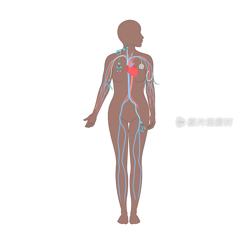 中心静脉导管类型对女性身体