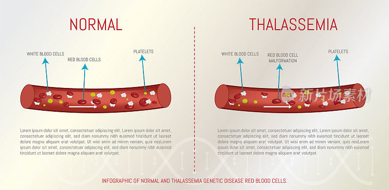 正常和地中海贫血遗传疾病的红细胞信息图。