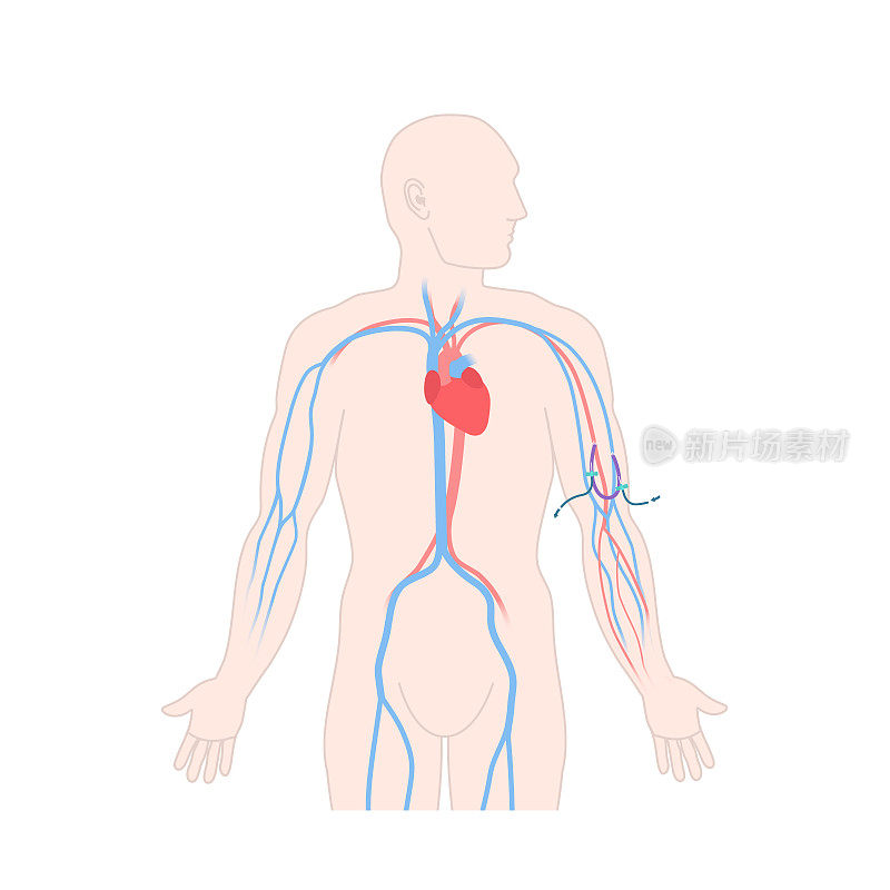 男性手臂动静脉透析分流移植物导管